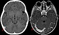 CT ohne Kontrastmittel (links), und der gleiche Fall im MR mit Kontrastmittel. Thrombus durch roten Pfeil gekennzeichnet.