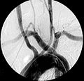 Angiografía mostrando arteria subclavia aberrante derecha