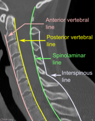 Cervical lines are annotations used in medical imaging of the cervical vertebrae, here seen on X-ray and CT, respectively. Incongruencies indicate cervical fracture, spondylolisthesis and/or ligament injury.