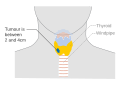 Stage T2 thyroid cancer