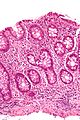 Micrograph showing intestinal crypt branching, a histopathological finding of chronic colitides. H&E stain.