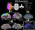 Processo di acquisizione da una risonanza magnetica della intera rete strutturale di un cervello.