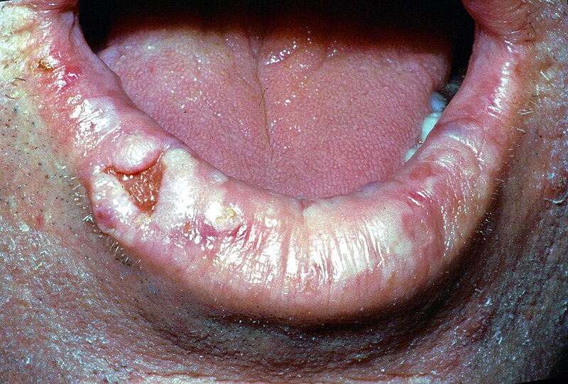 File:Lower lip cancer.jpg