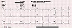 EKG från en frisk 26-årig man.