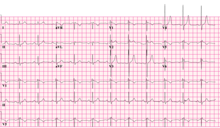 Type 2 Brugada ECG pattern