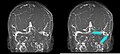 Thrombose des linken Sinus transversus in der MR-Angiographie (koronare MIP von vorne gesehen).