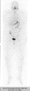 Scintigraphie corps entier : test à 131I (370 MBq). Activité physiologique : glandes salivaires, estomac, intestin et vessie. Pas de stockage dans la thyroïde.