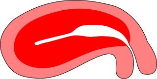 Uterus Distortion2.svg