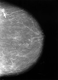 Mammogram showing small lesion