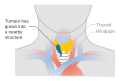 Stage T4a thyroid cancer