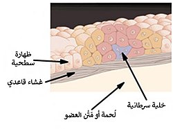 سرطانة لابدة