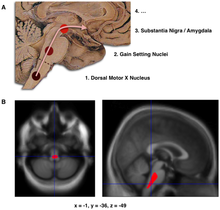 Composite of three images, one in top row (referred to in caption as A), two in second row (referred to as B). Top shows a mid-line مستوى سهمي of the brainstem and مخيخ. There are three circles superimposed along the brainstem and an arrow linking them from bottom to top and continuing upward and forward towards the frontal lobes of the brain. A line of text accompanies each circle: lower is "1. Dorsal Motor X Nucleus", middle is "2. Gain Setting Nuclei" and upper is "3. Substantia Nigra/Amygdala". The fourth line of text above the others says "4....". The two images at the bottom of the composite are magnetic resonance imaging (MRI) scans, one sagittal and the other transverse, centred at the same brain coordinates (x=-1, y=-36, z=-49). A colored blob marking volume reduction covers most of the brainstem.