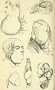 Operative surgery illustrated - containing more than nineteen hundred engravings - including two hundred original, and fifty colored drawings- with explanatory text (1852) (14578974189).jpg