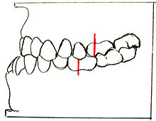 Angle-Klasse III