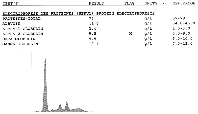 File:Serum protein electrophoresis normal results.jpg