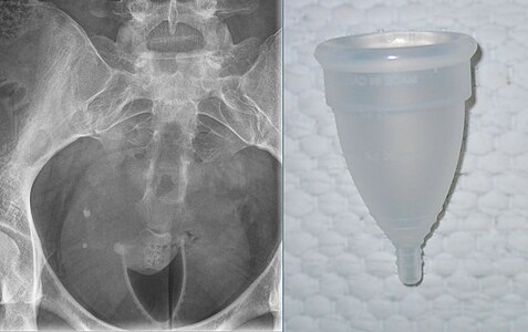 An X-ray that shows a bell-shaped menstrual cup in place. The cervix can be seen in the mouth of the cup; the cup rim is in the vaginal fornix. Bell-shaped cups have the same shape when in use inside the body as outside, and create an empty space (black on the X-ray).