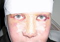 Recovering rhinoplasty patient