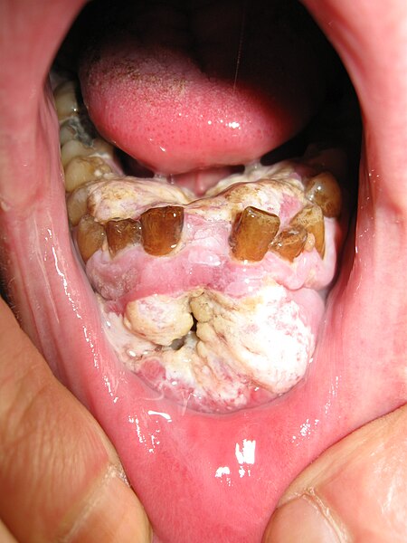 File:Mouth cancer bionerd.jpg