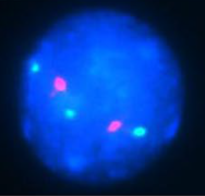 This cell displays 2 signals of HER2 (red) and 3 signals of CEP17 (green)