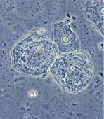 Phase contrast microscopy of clue cells in a vaginal swab