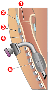 Diagram of a tracheostomy tube in the trachea