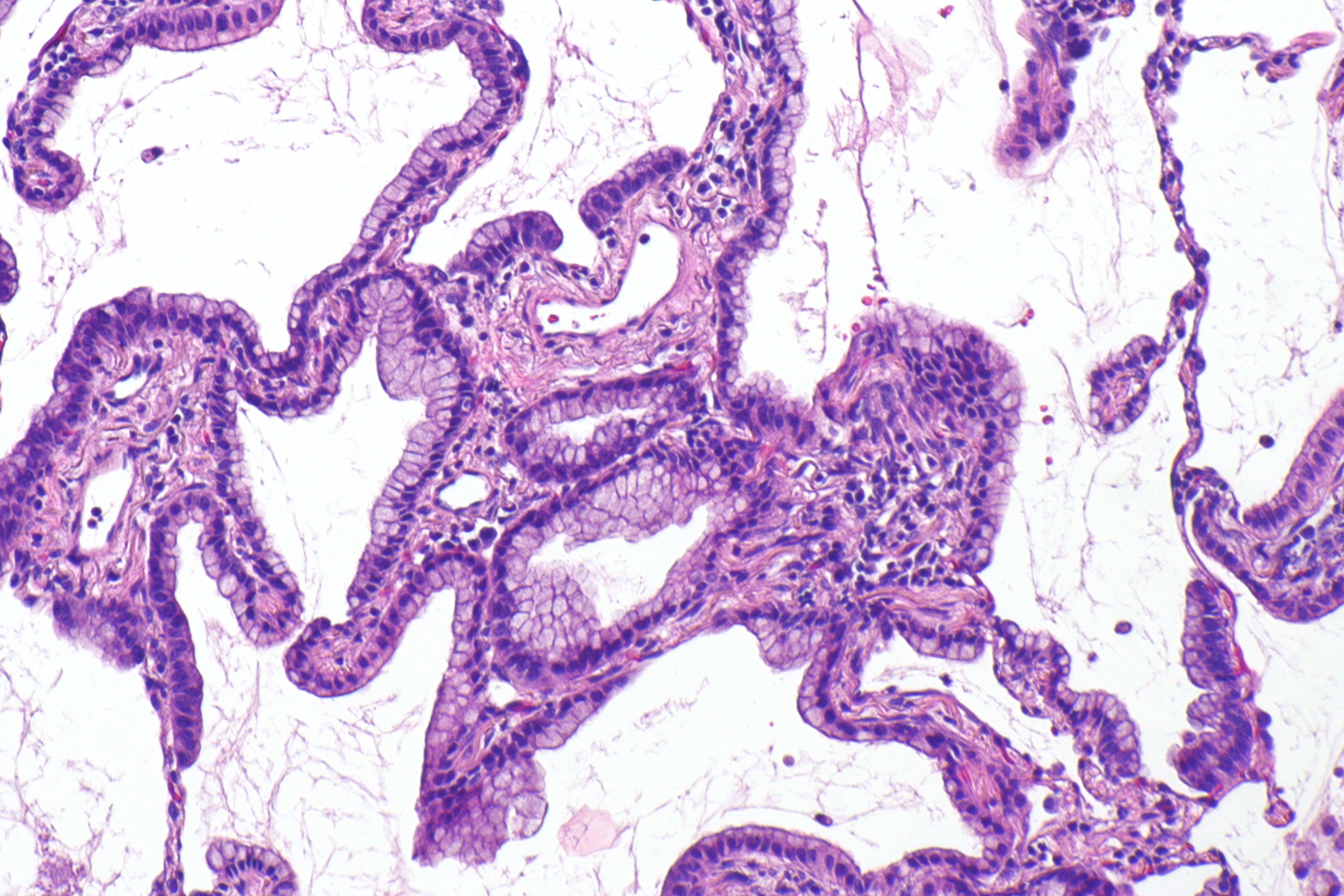 Mucinous_lung_adenocarcinoma_--_intermed_mag