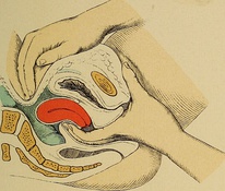 Image showing an anteverted uterus lying above the bladder (above), compared with a retroverted uterus undergoing bimanual examination facing towards the rectum (below)