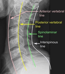 Cervical lines are annotations used in medical imaging of the cervical vertebrae, here seen on X-ray and CT, respectively. Incongruencies indicate cervical fracture, spondylolisthesis and/or ligament injury.