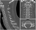 Scrollable computed tomography images of normal cervical vertebrae