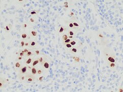 Immunohistochemistry stain for SOX10 in a poorly differentiated metastatic melanoma to a lymph node, helping in its diagnosis.