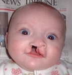 Six-month-old girl before going into surgery to have her unilateral complete cleft lip repaired