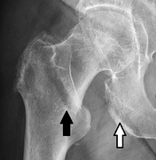 A hip fracture (black arrow) next to a skin fold (white arrow)