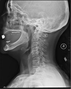 X-rays (left) are more available, but can miss details like herniated disks that MRIs can show (right).[89]