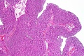 Papillary transitional cell carcinoma, low grade