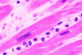 Neutrophils are seen in a myocardial infarction at approximately 12–24 hours,[64] as seen in this micrograph.