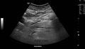 Identifying pancreas on abdominal ultrasonography when it is partly obscured by bowel gas.