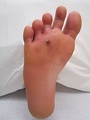 An infected puncture wound to the bottom of the forefoot