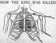 Illustration of a ribcage with three points of impact on the person's left side