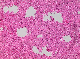 Tearing artifacts, such as can be caused by: - Microtomy with a nick or blemish in the knife edge.[5] - Traction of the sections. - Too much or too little alcohol dehydration.[5] - Sectioning calcified parts, which can be decalcified or removed.[5]