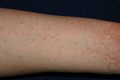 Scabies of the arm