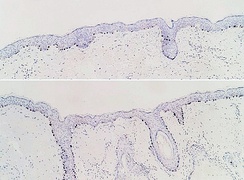 SOX10 immunohistochemistry of normal skin (top) and atypical melanocytic proliferation (bottom), seen mainly in hair follicles.