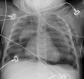 Pneumomediastinum with angel wing sign[15]