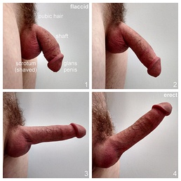 Side views and comparison of the stages of both uncircumcised and circumcised human penis erection.