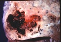 Pathology image of a lung abscess.