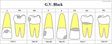 Chart showing digitally drawn images of caries locations and their associated classifications.