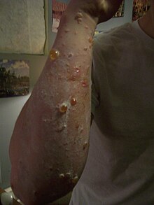 Blisters distributed over an adult forearm