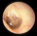 This is a normal left eardrum.