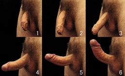 Side views and comparison of the stages of both uncircumcised and circumcised human penis erection.