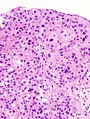 Histopathology of urothelial carcinoma of the urinary bladder, showing a nested pattern of invasion. Transurethral biopsy. H&E stain