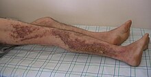 Many hyperkeratotic, vegetative, and hyperpigmented papules in a zosteriform pattern on the right lateral lower extremity of an adult